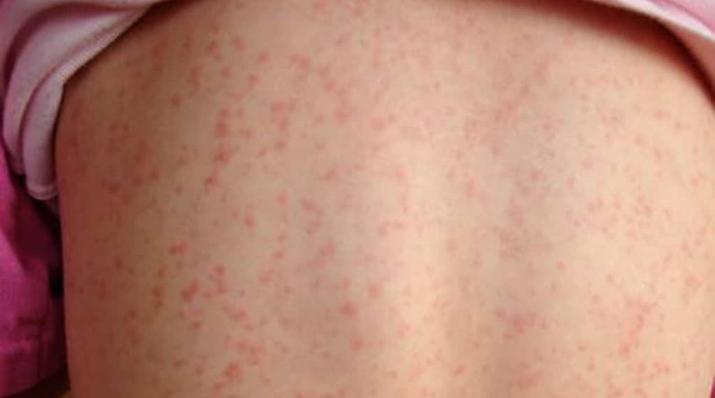 Detectan caso de escarlatina en liceo de Talca: activan protocolo sanitario